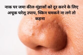 Skin Home Remedies : नाक पर जमा कील-मुंहासों को दूर करने के लिए अचूक घरेलू उपाय, स्किन चमकने ना लगे तो कहना