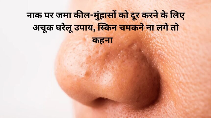 Skin Home Remedies : नाक पर जमा कील-मुंहासों को दूर करने के लिए अचूक घरेलू उपाय, स्किन चमकने ना लगे तो कहना